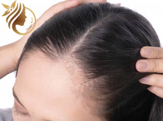 علت ریزش شدید مو در زنان