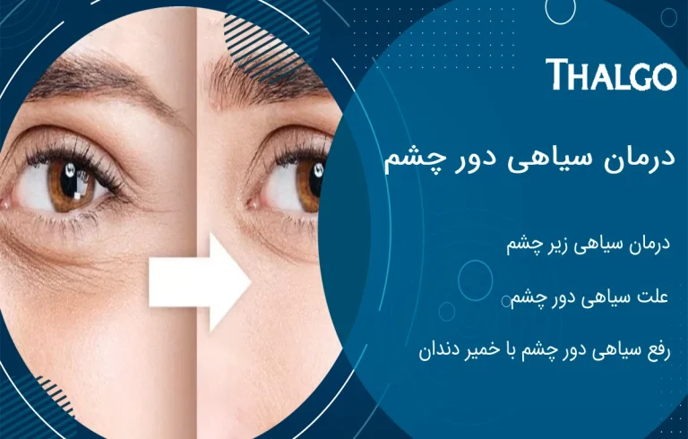 رفع و درمان سیاهی دور چشم | علت سیاهی دور چشم از نظر طب سنتی